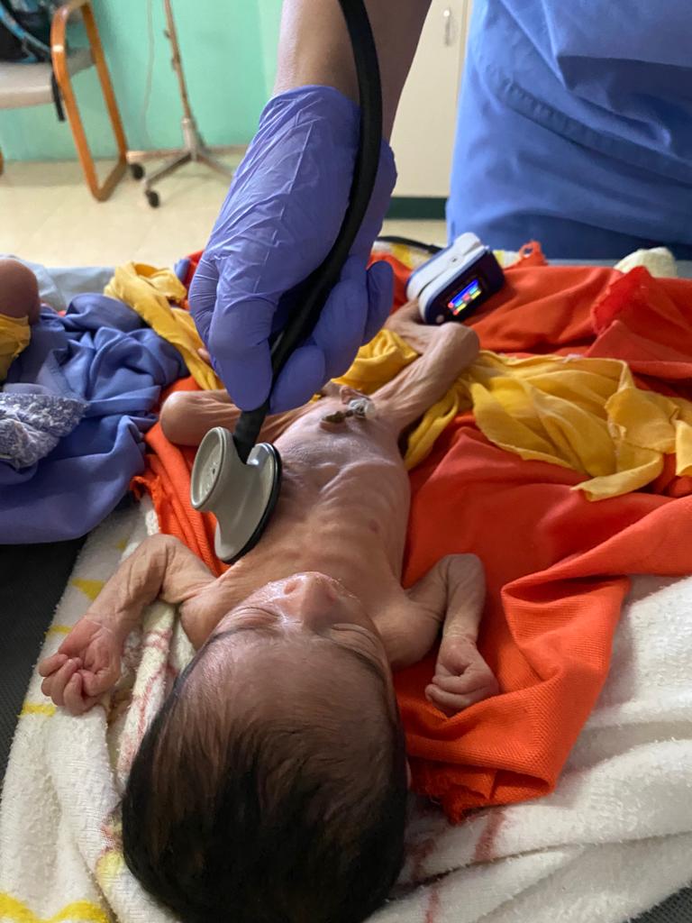 gloved hand using stethoscope on emaciated infant