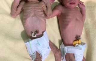 emaciated twins await medical treatment